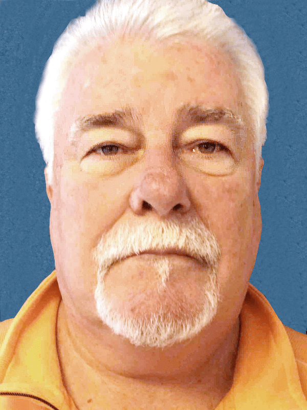 Excision Nose Patient 01 Before - 2