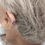 Mohs Ear Patient 01 Thumbnail Before