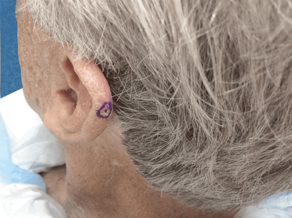 Mohs Ear Patient 01 Before