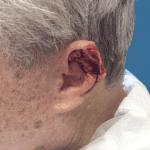 Mohs Ear Patient 01 Thumbnail After