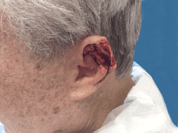 Mohs Ear Patient 01 After