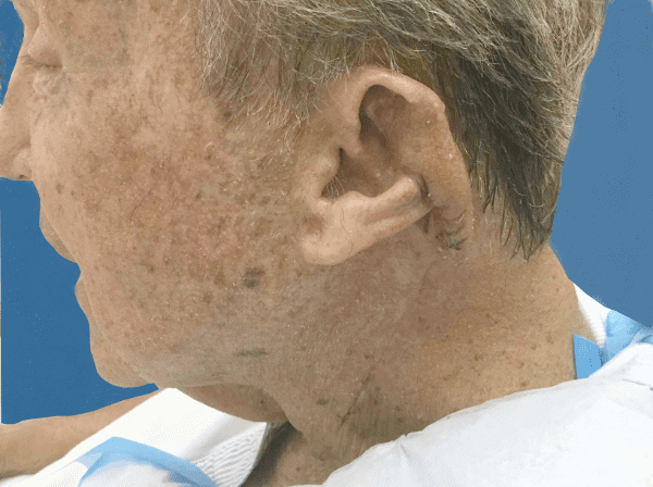 Mohs Ear Patient 01 Before - 2