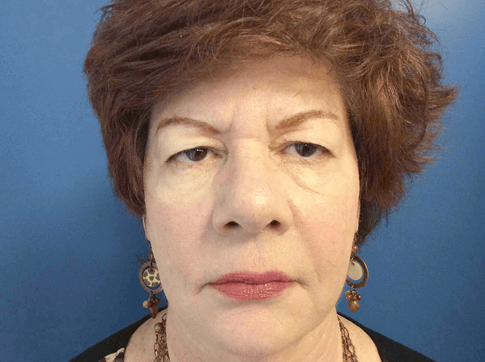 Blepharoplasty Patient 01 Before