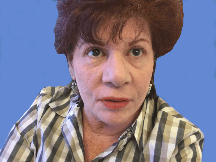 Blepharoplasty Patient 01 Before - 2