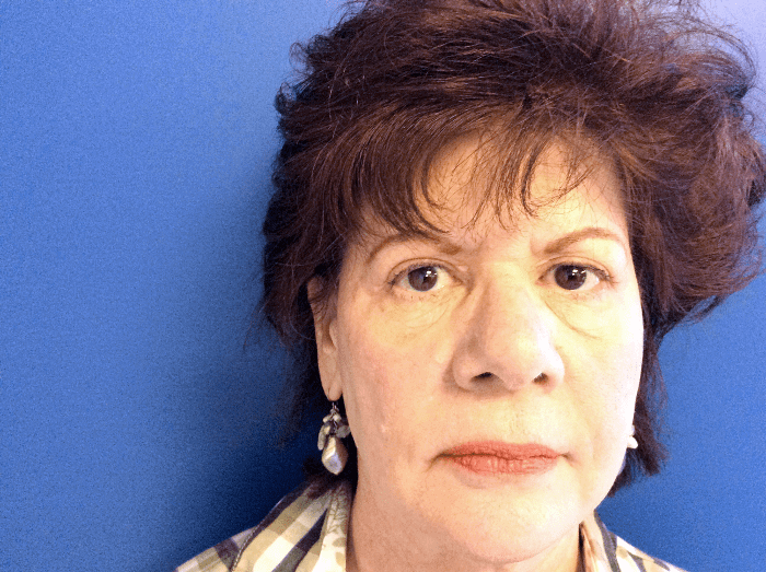 Blepharoplasty Patient 01 After - 2