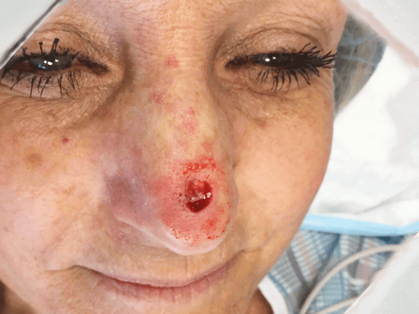 Mohs Nose Patient 16 After