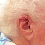 Mohs Ear Patient 04 Thumbnail Before