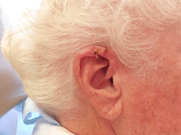 Mohs Ear Patient 04 Before