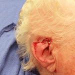 Mohs Ear Patient 04 Thumbnail After