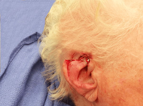 Mohs Ear Patient 04 After