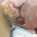 Mohs Ear Patient 04 Thumbnail Before - 2