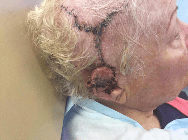 Mohs Ear Patient 04 Before - 2