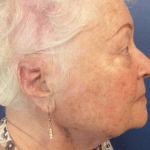 Mohs Ear Patient 04 Thumbnail After - 2