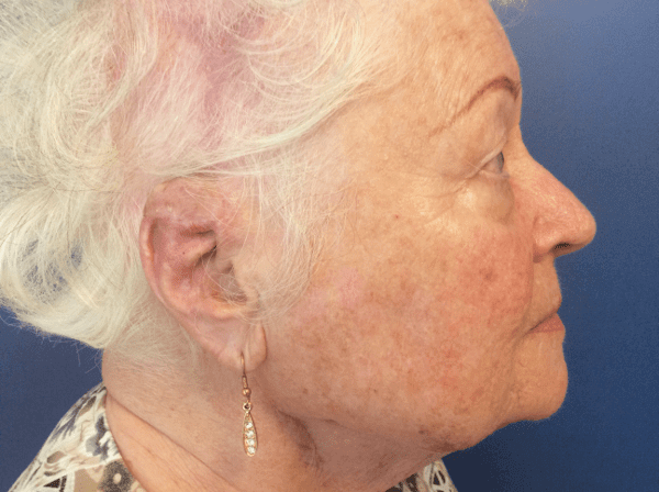 Mohs Ear Patient 04 After - 2