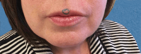 Mohs Lips Patient 03 Before