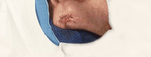 Mohs Lips Patient 03 Before - 2