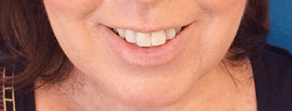 Mohs Lips Patient 03 After - 2