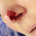 Mohs Nose Patient 11 Thumbnail After