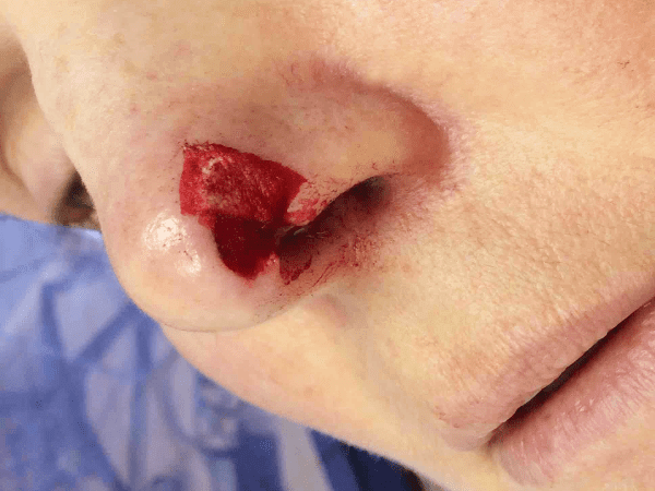 Mohs Nose Patient 11 After