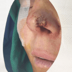 Mohs Nose Patient 11 Thumbnail Before - 2