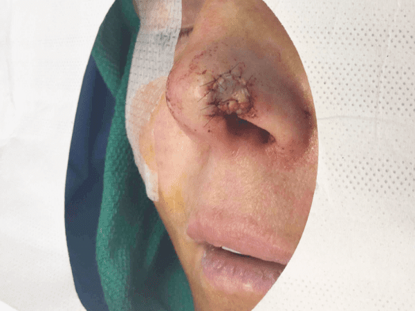 Mohs Nose Patient 11 Before - 2