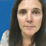 Mohs Nose Patient 11 Thumbnail After - 2