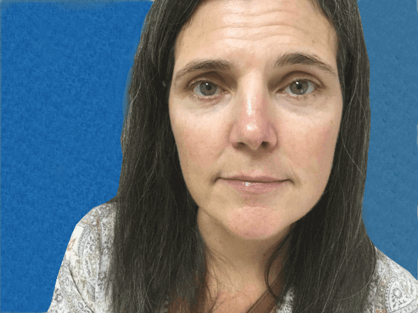 Mohs Nose Patient 11 After - 2