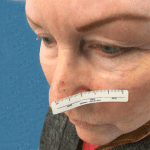 Mohs Nose Patient 15 Thumbnail Before