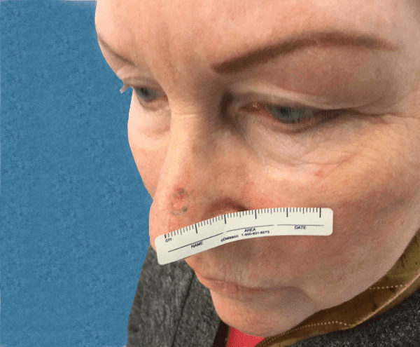 Mohs Nose Patient 15 Before