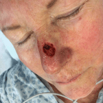 Mohs Nose Patient 15 Thumbnail After