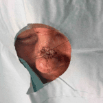 Mohs Nose Patient 15 Thumbnail Before - 2