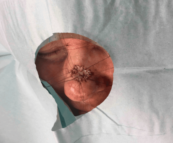 Mohs Nose Patient 15 Before - 2