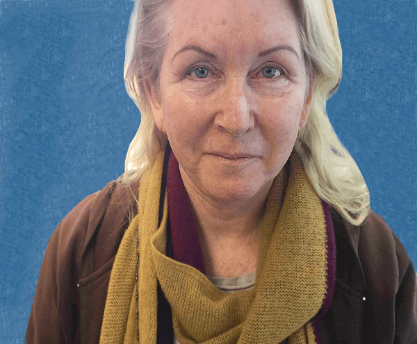 Mohs Nose Patient 15 After - 2