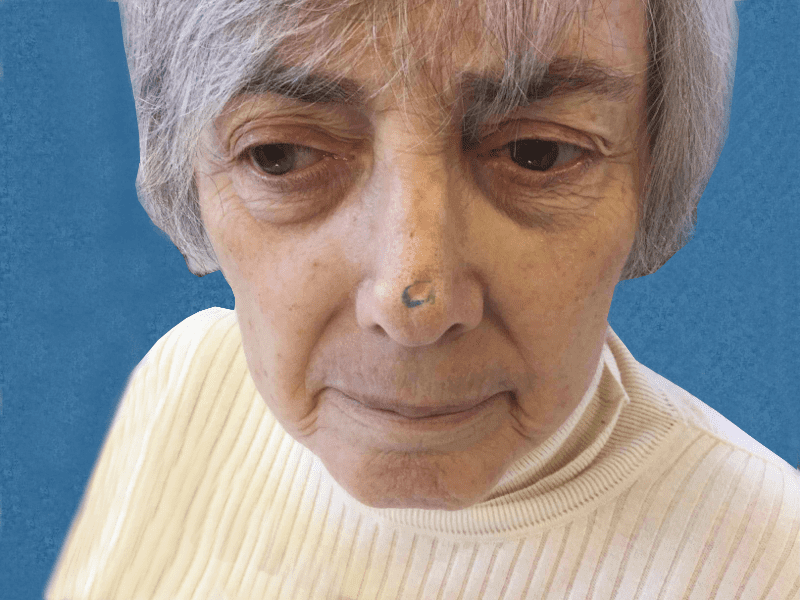 Mohs Nose Patient 13 Before