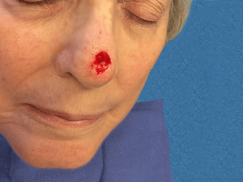 Mohs Nose Patient 13 After