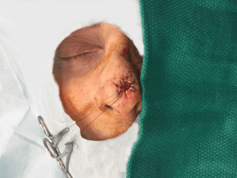 Mohs Nose Patient 13 Before - 2