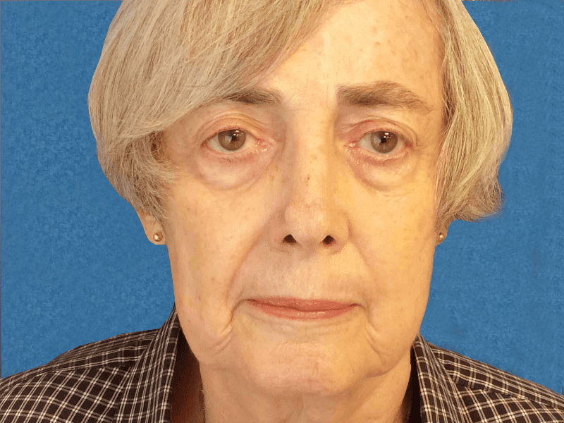 Mohs Nose Patient 13 After - 2