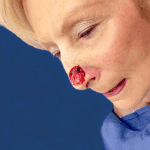 Mohs Nose Patient 10 Thumbnail After