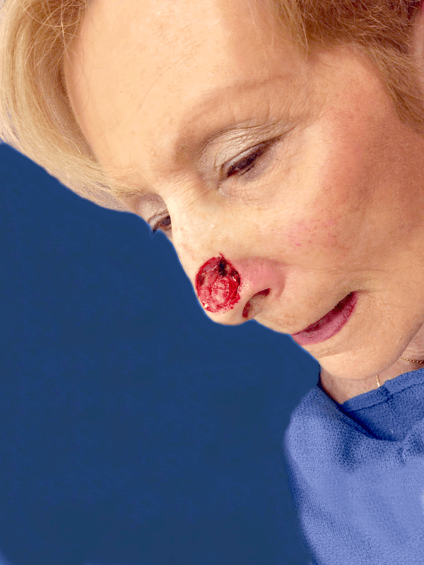 Mohs Nose Patient 10 After