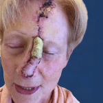 Mohs Nose Patient 10 Thumbnail Before - 2