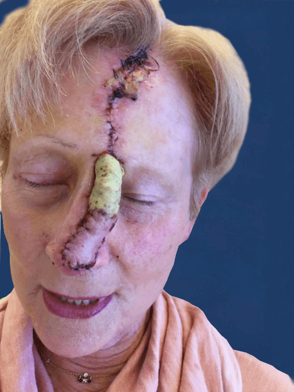 Mohs Nose Patient 10 Before - 2