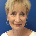 Mohs Nose Patient 10 Thumbnail After - 2