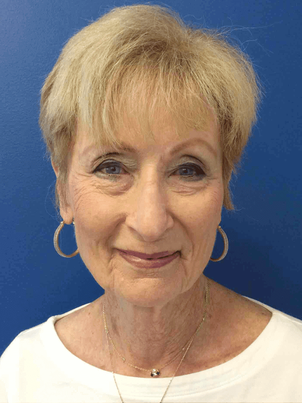 Mohs Nose Patient 10 After - 2