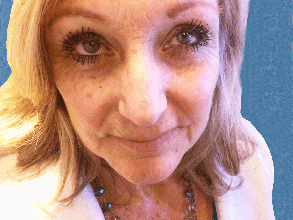 Mohs Nose Patient 16 Before