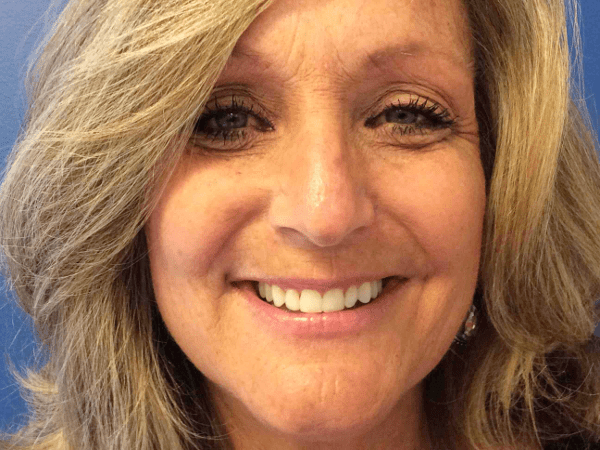 Mohs Nose Patient 16 After - 2