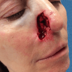 Mohs Nose Patient 14 Thumbnail After