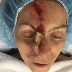 Mohs Nose Patient 14 Thumbnail Before - 2