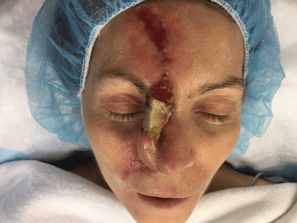 Mohs Nose Patient 14 Before - 2