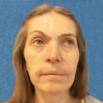 Mohs Nose Patient 14 Thumbnail After - 2