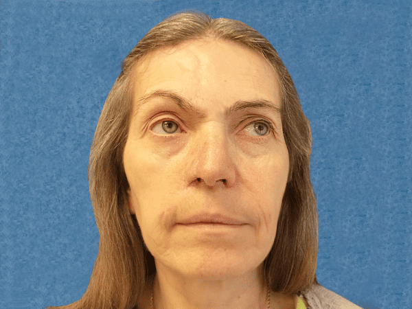 Mohs Nose Patient 14 After - 2